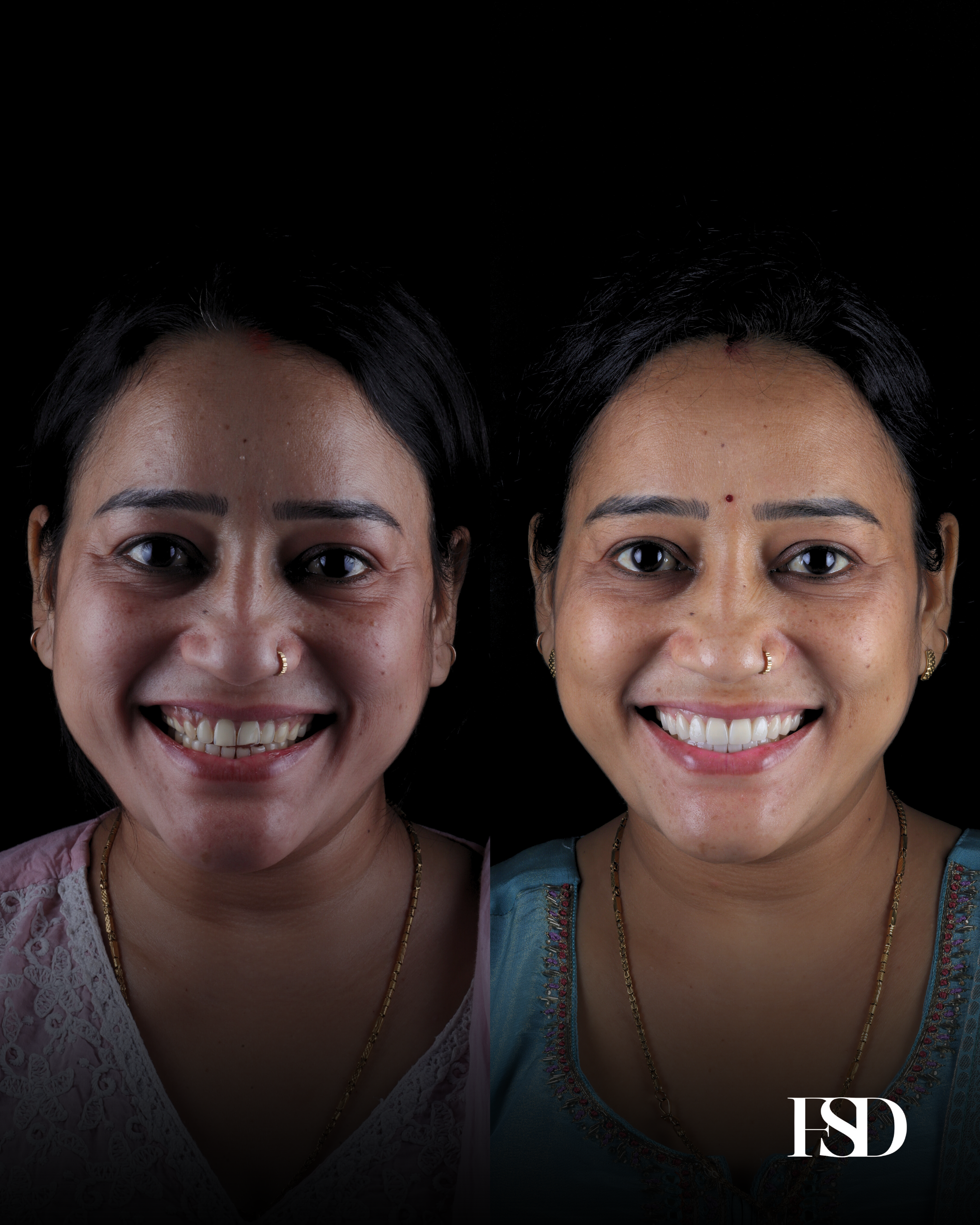 Extra Oral
